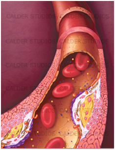 Atherosclerosis cover