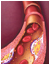 Atherosclerosis cover